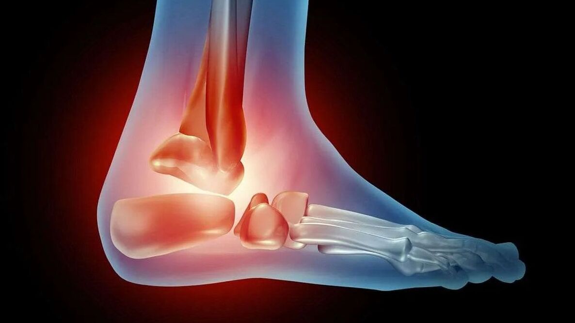 ankle osteoarthritis diagram