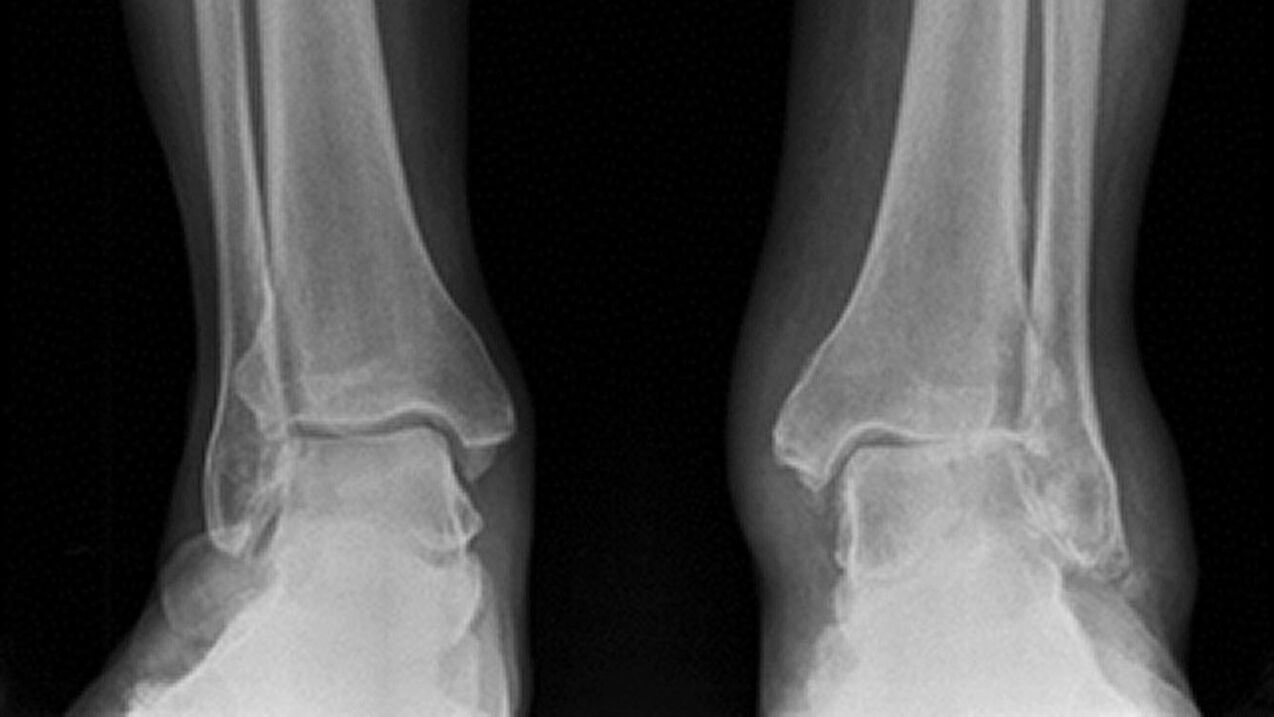x-ray of ankle