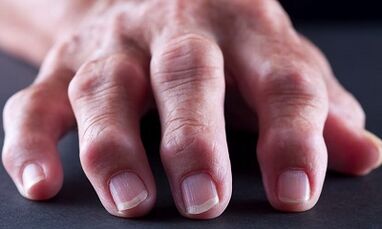 What is the difference between arthritis