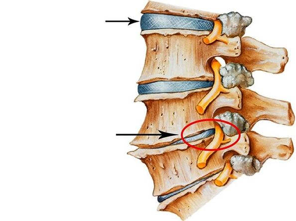 Disorders of intervertebral discs