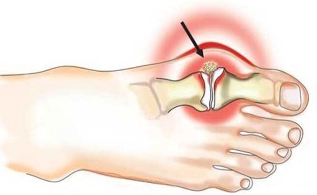 Inflammation of the joint between the big toe and the foot due to gout