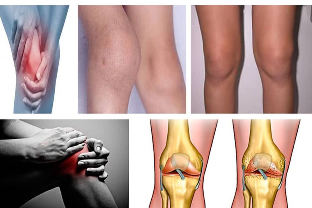 osteoarthritis what is it