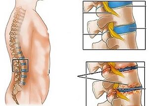 The causes of osteocondrosis in the lower back