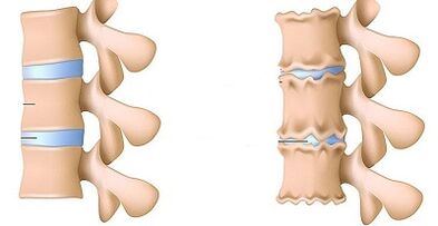 how to recognize the presence of osteocondrosis of the lower back