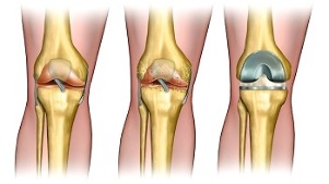 arthroplasty against osteoarthritis of the knee joint